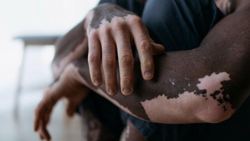 Vitiligo : un premier traitement autorisé et remboursé en France