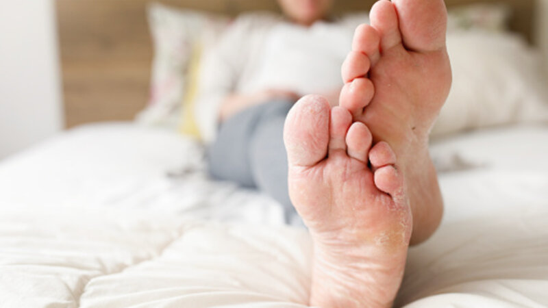 Les mycoses de la peau : comment les prévenir et les traiter ?