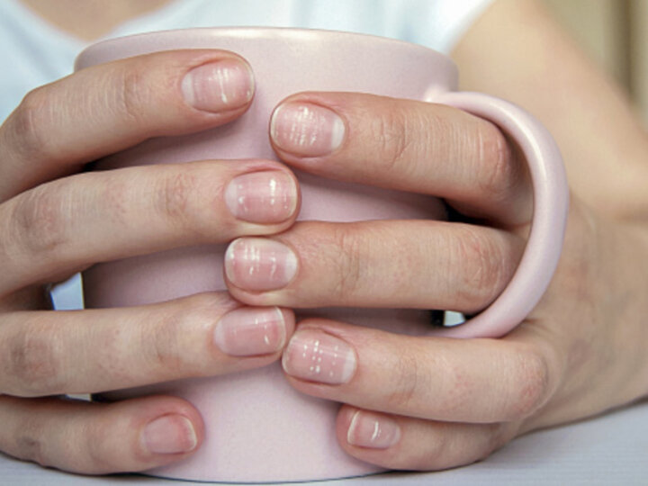 Altérations de l’ongle sous traitement anticancer