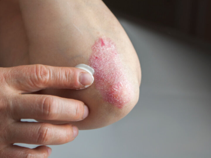 Qu’est-ce que le psoriasis ?