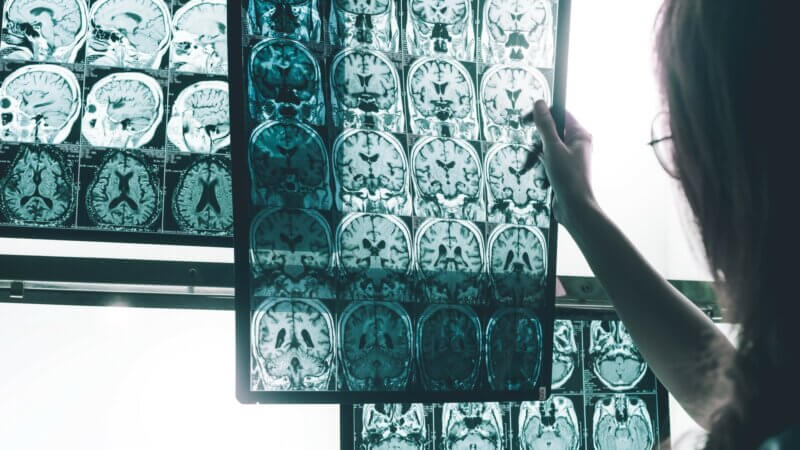 5 personnes « attrapent » la maladie d’Alzheimer après un traitement médical