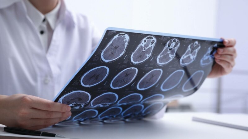 L’épilepsie : une maladie neurologique toujours mal connue