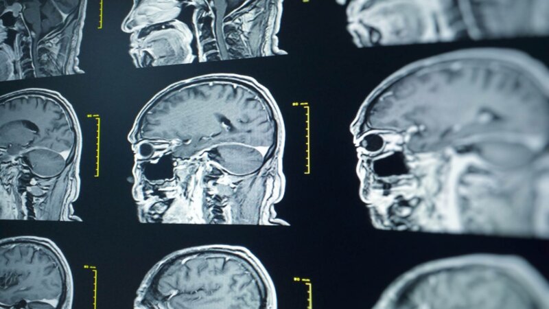 Qu’est-ce qu’un hématome sous-dural ?