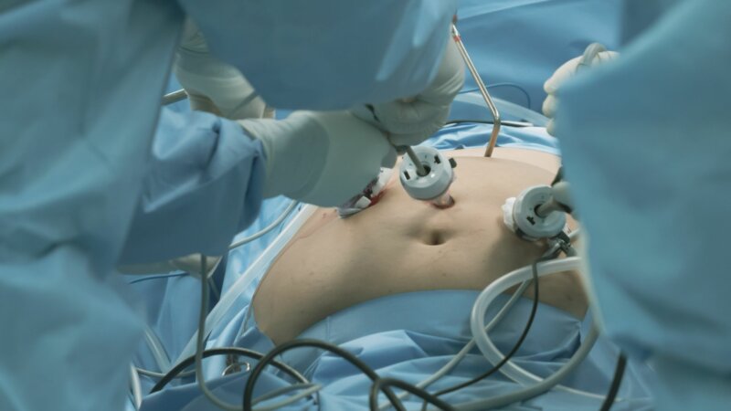 Journée mondiale de l’obésité : 6 questions sur la chirurgie bariatrique