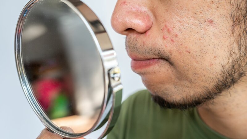 Un adulte sur cinq touchée par l’acné dans le monde