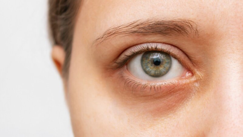 Pourquoi a-t-on des cernes sous les yeux et comment s’en débarrasser ?  