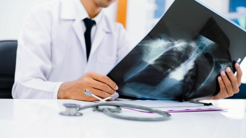 Cancer du poumon : bientôt un dépistage organisé par scanner faible dose ?