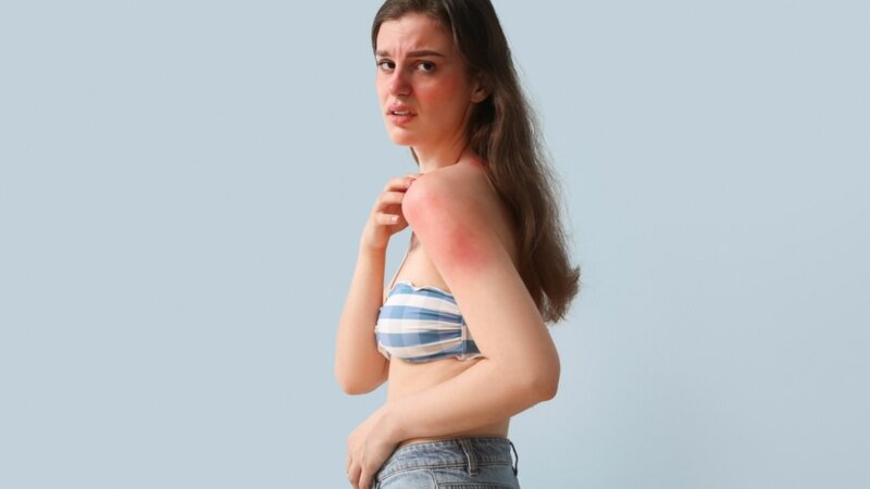 Allergie au soleil : qu’est-ce que la lucite estivale bénigne ?