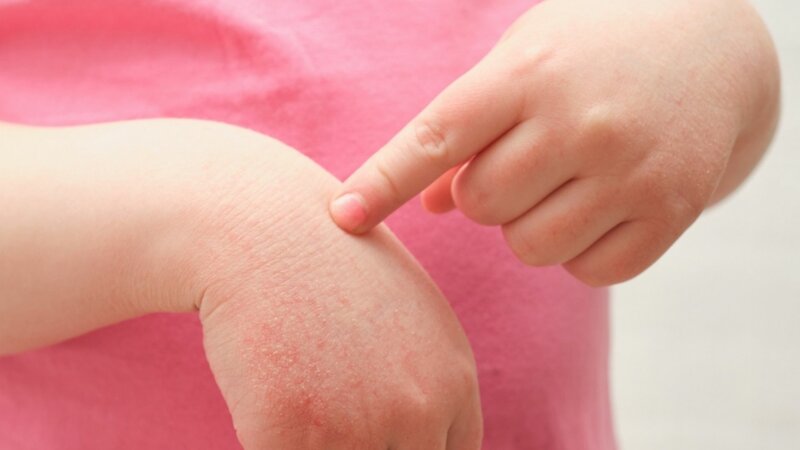 L’obésité infantile, facteur de risque de certaines maladies de la peau