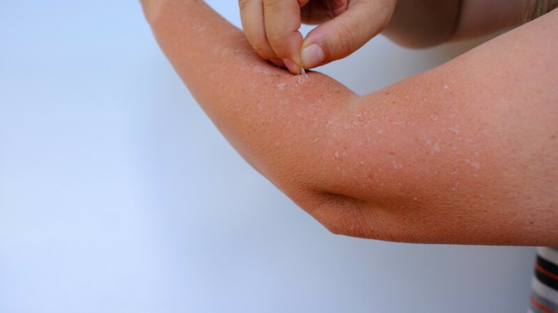 Coup de soleil : pourquoi la peau pèle-t-elle ?