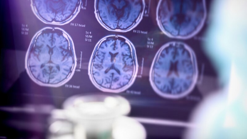 Maladie d’Alzheimer : l’Agence européenne du médicament autorise le Leqembi