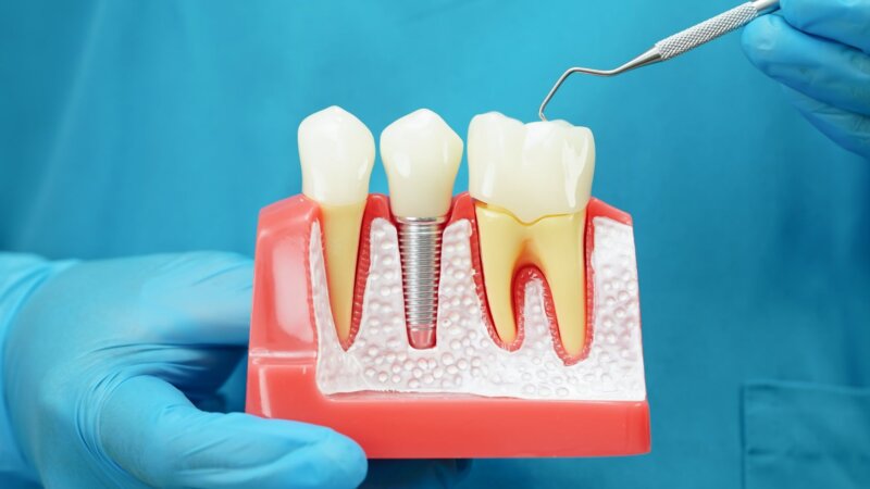 Les implants et prothèses dentaires enfin remboursés ?