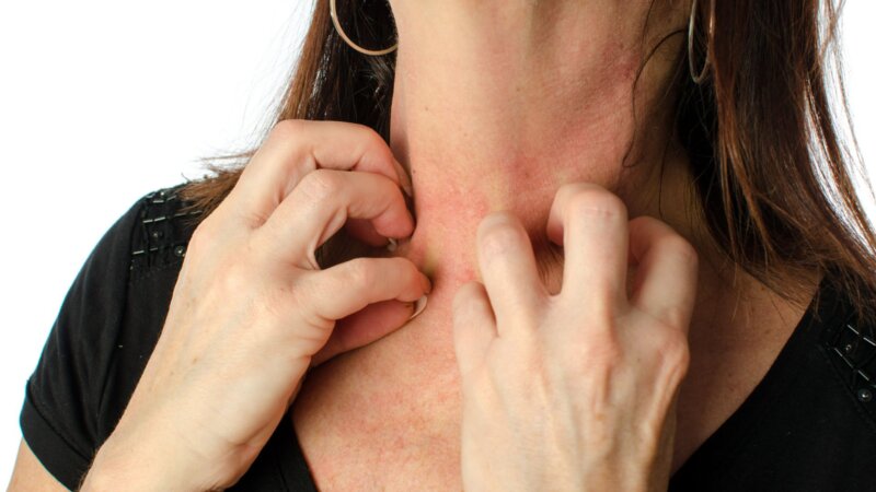 Eczéma de contact : attention aux huiles essentielles !