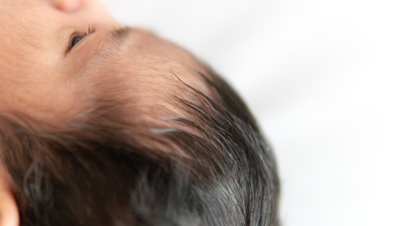 Une lotion anti-calvitie provoque un syndrome du loup-garou chez 11 enfants