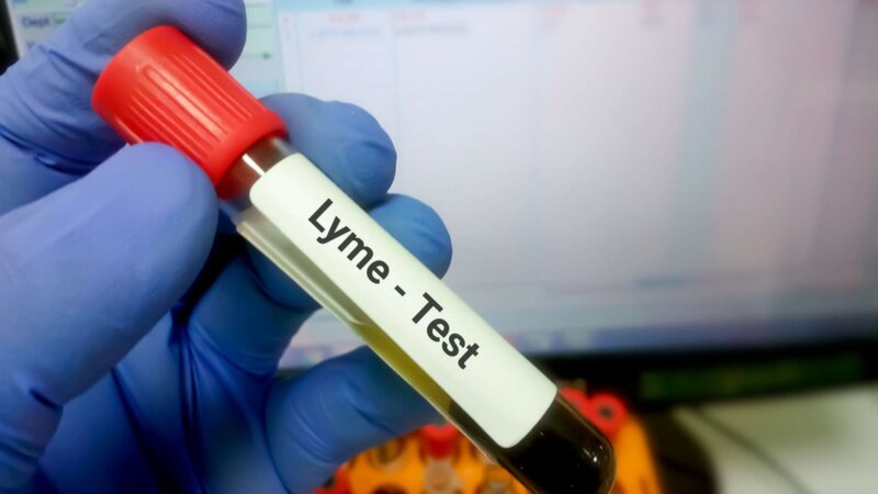 Le syndrome post-borréliose de Lyme : quand les symptômes persistent après le traitement