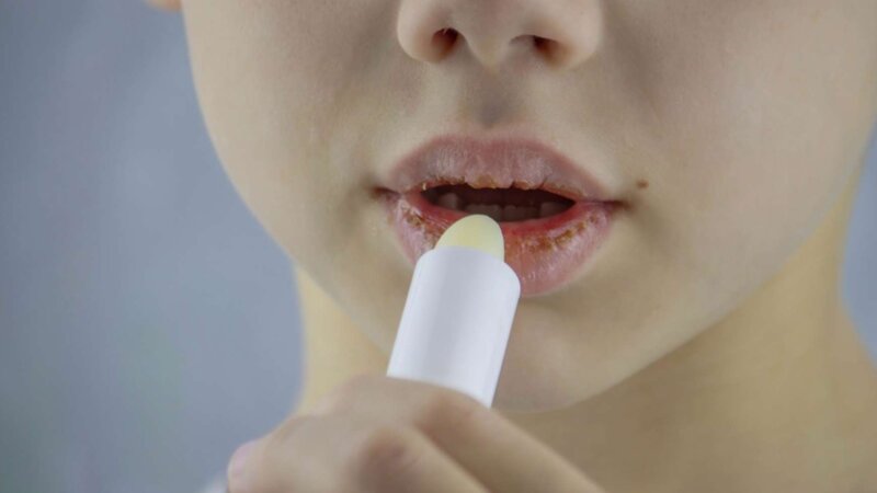 Lèvres sèches ou gercées : que faire ?