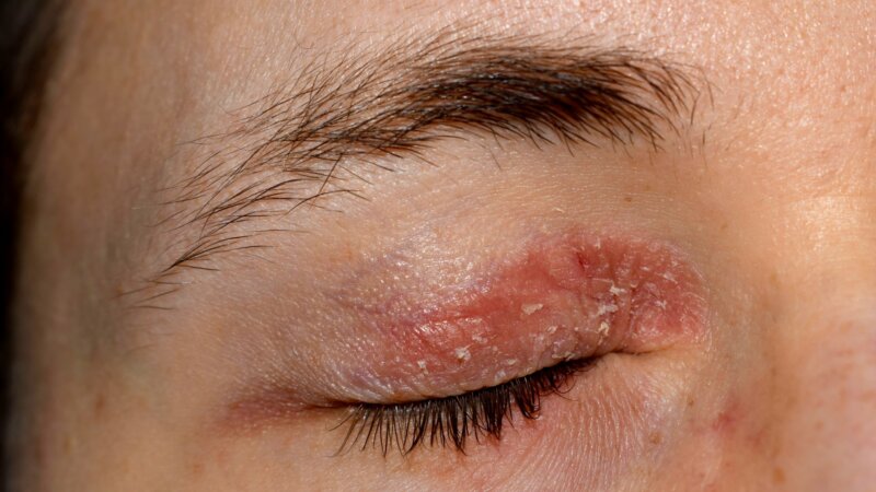 Eczéma : les paupières, une zone particulièrement fragile