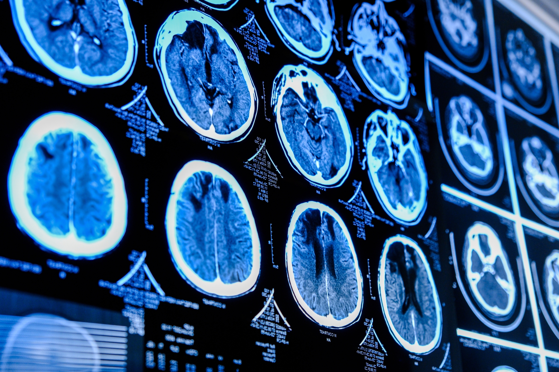 Pourquoi le cancer du cerveau résiste-t-il souvent à l’immunothérapie ?