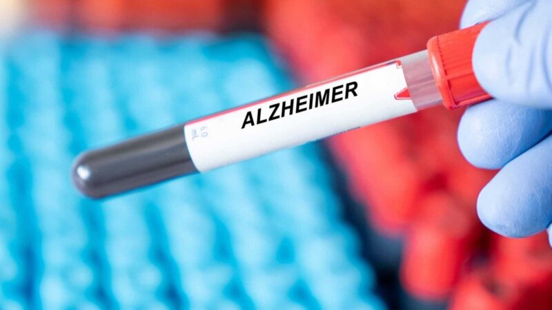 Alzheimer : un test sanguin capable de dépister et suivre l’évolution de la maladie