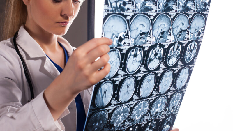 Diagnostic, traitement… du nouveau dans la sclérose en plaques