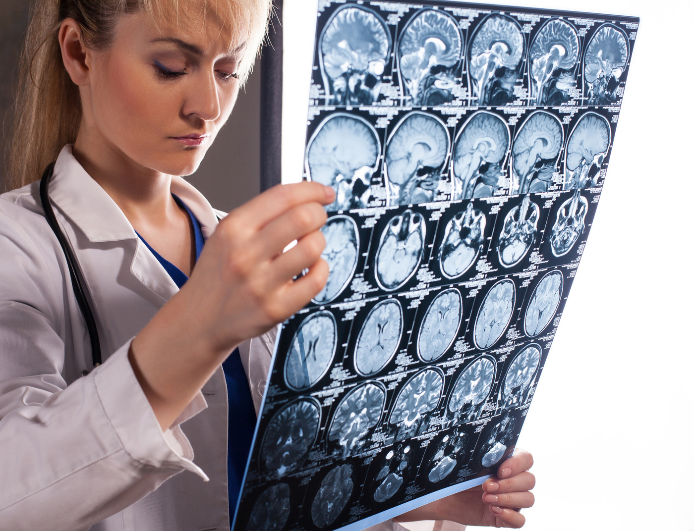 Diagnostic, traitement… du nouveau dans la sclérose en plaques