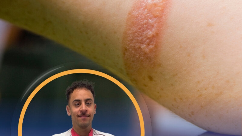 Comment soigner une brûlure légère ? (vidéo)