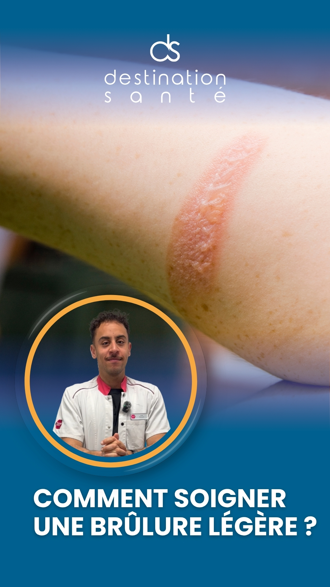 Comment soigner une brûlure légère ? (vidéo)