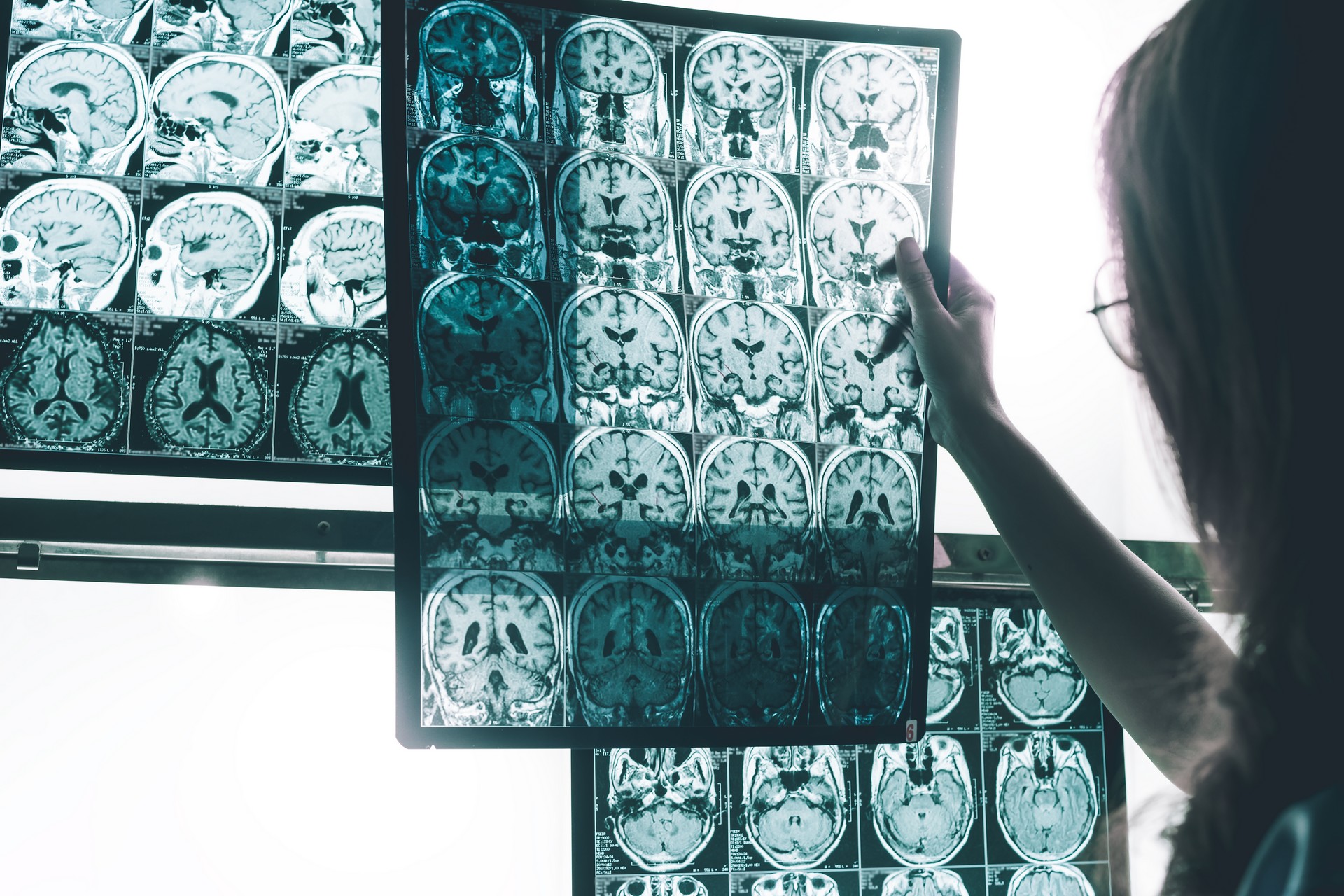 Peut-on mourir de la maladie d’Alzheimer ?