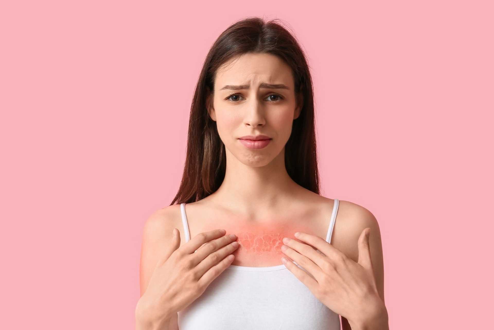 Photosensibilisation : quand soleil et médicaments ne font pas bon ménage