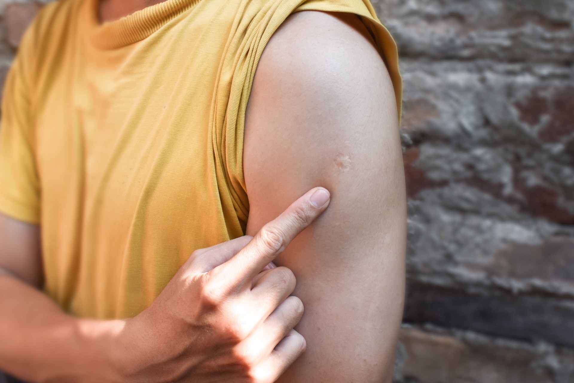 Pourquoi les vaccins contre la variole et le BCG laissent-ils des cicatrices ?
