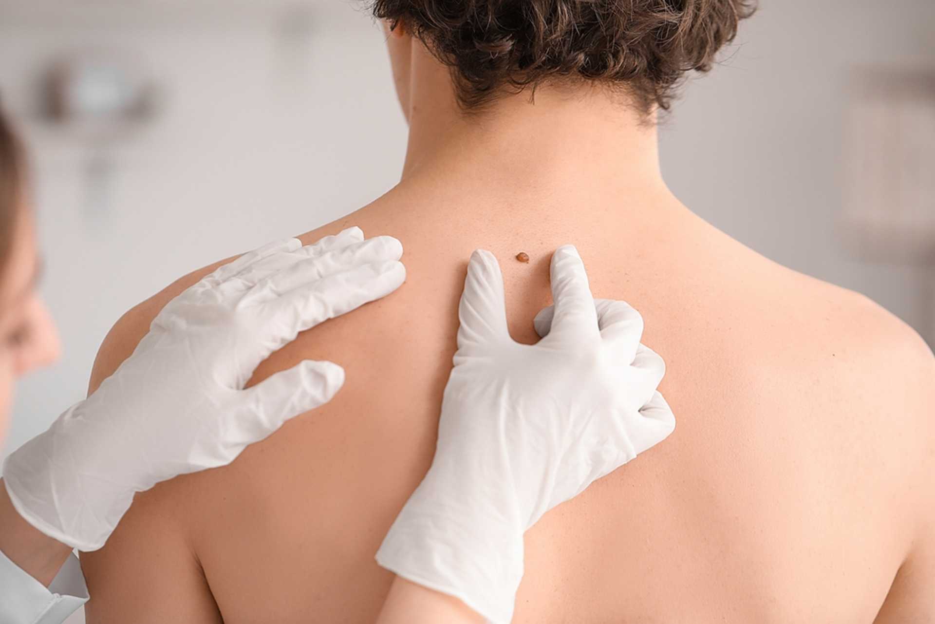 Cancer de la peau : la localisation des mélanomes diffère selon le sexe