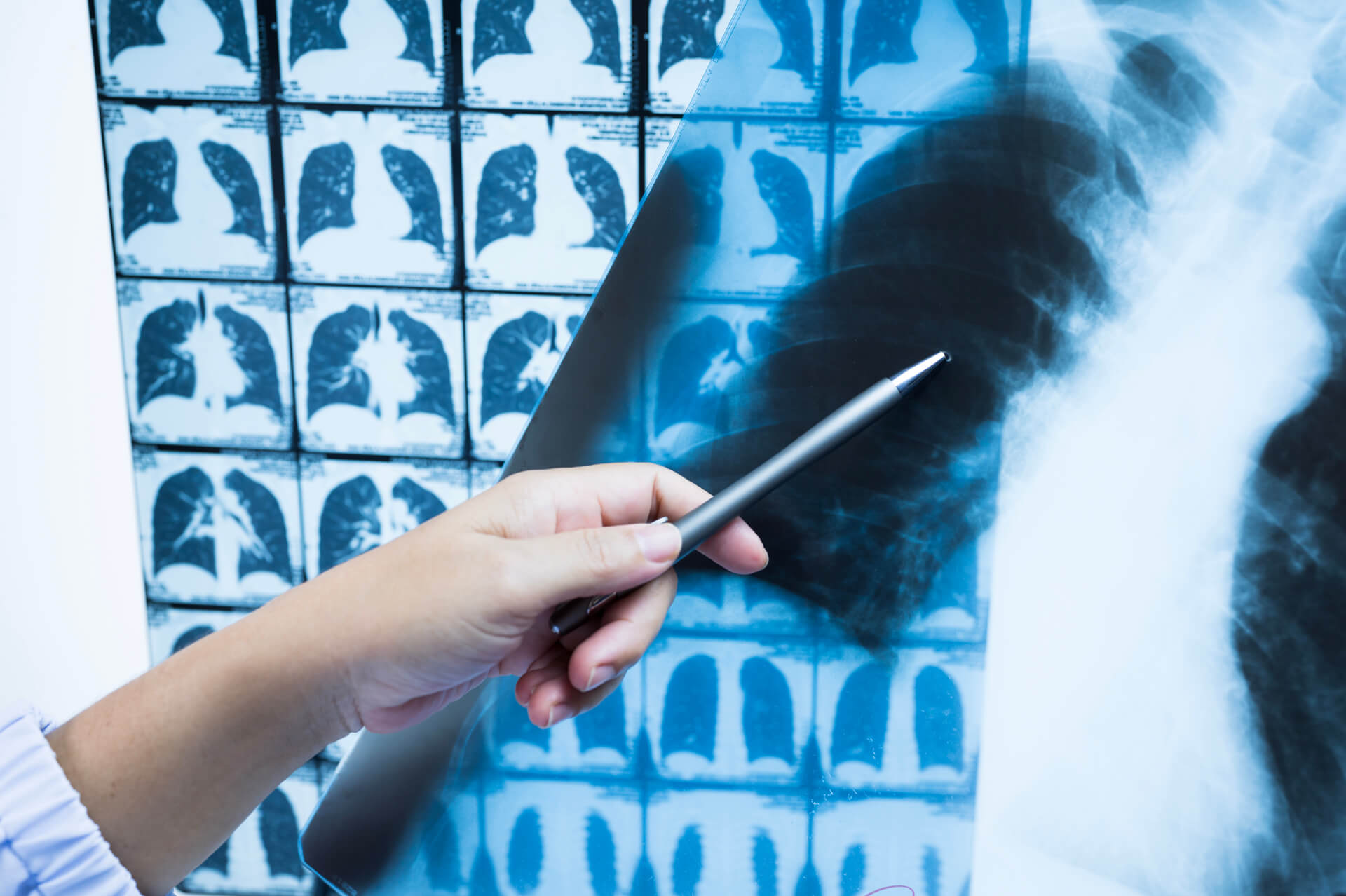 Cancer du poumon : la combinaison immunothérapie-chimiothérapie prolonge la vie des patients