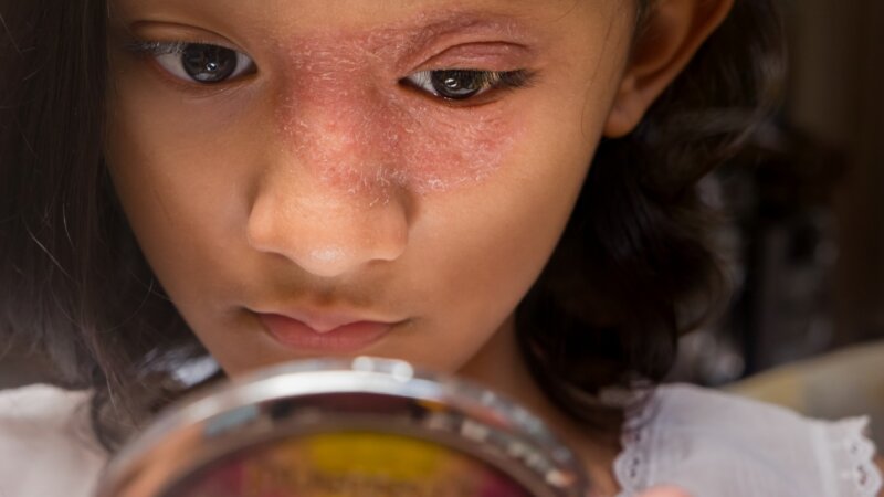 L’eczéma : une maladie qui pèse sur la santé mentale