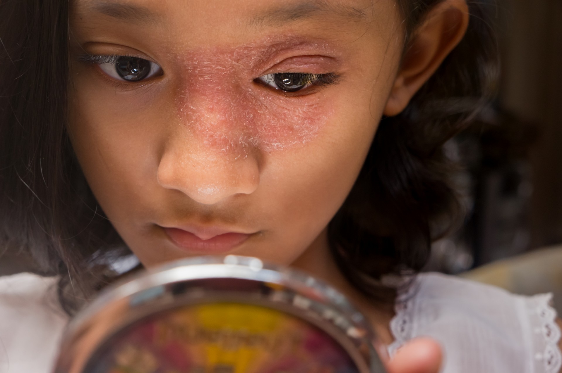 L’eczéma : une maladie qui pèse sur la santé mentale