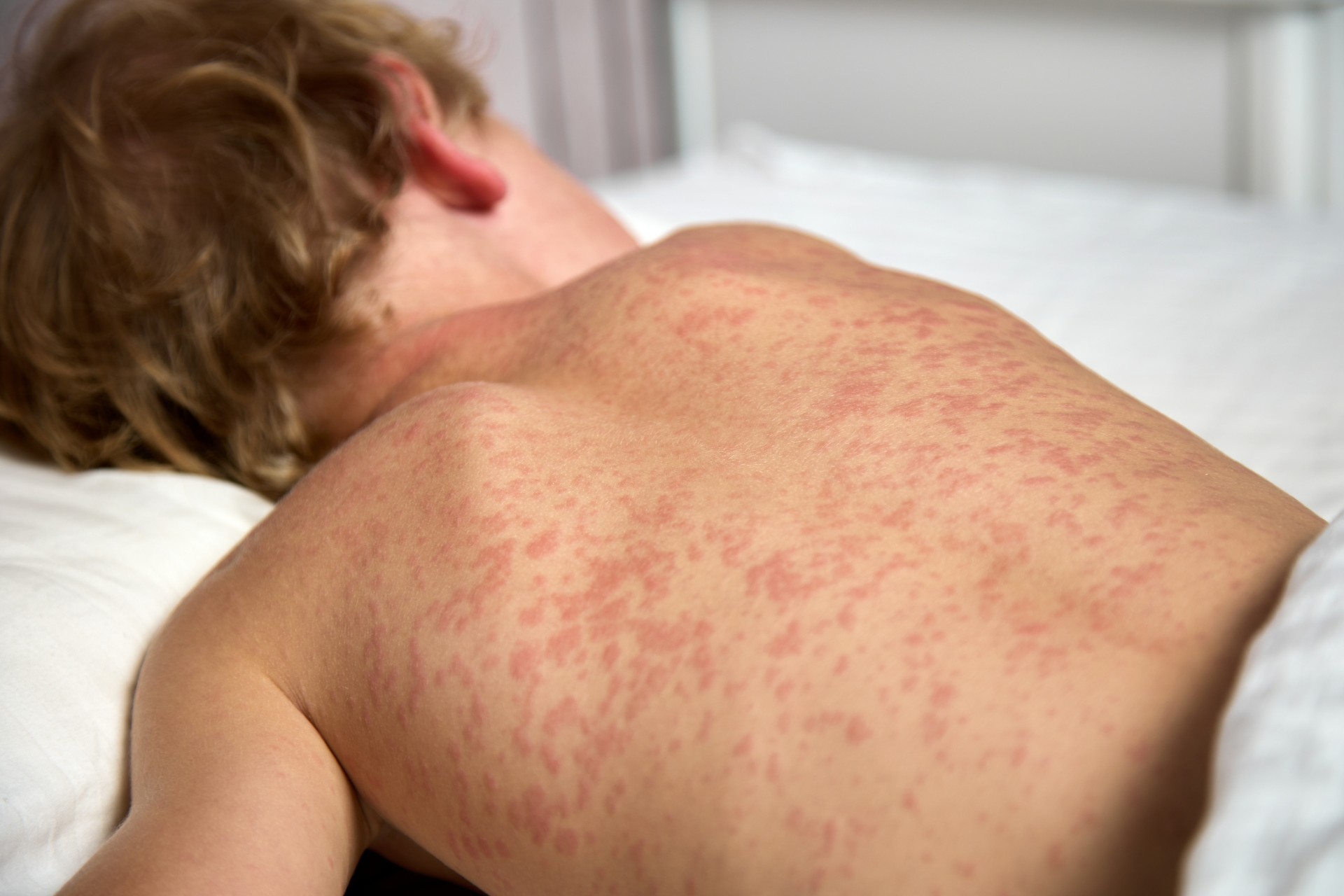 Hausse spectaculaire des cas de rougeole : êtes-vous correctement vacciné ?