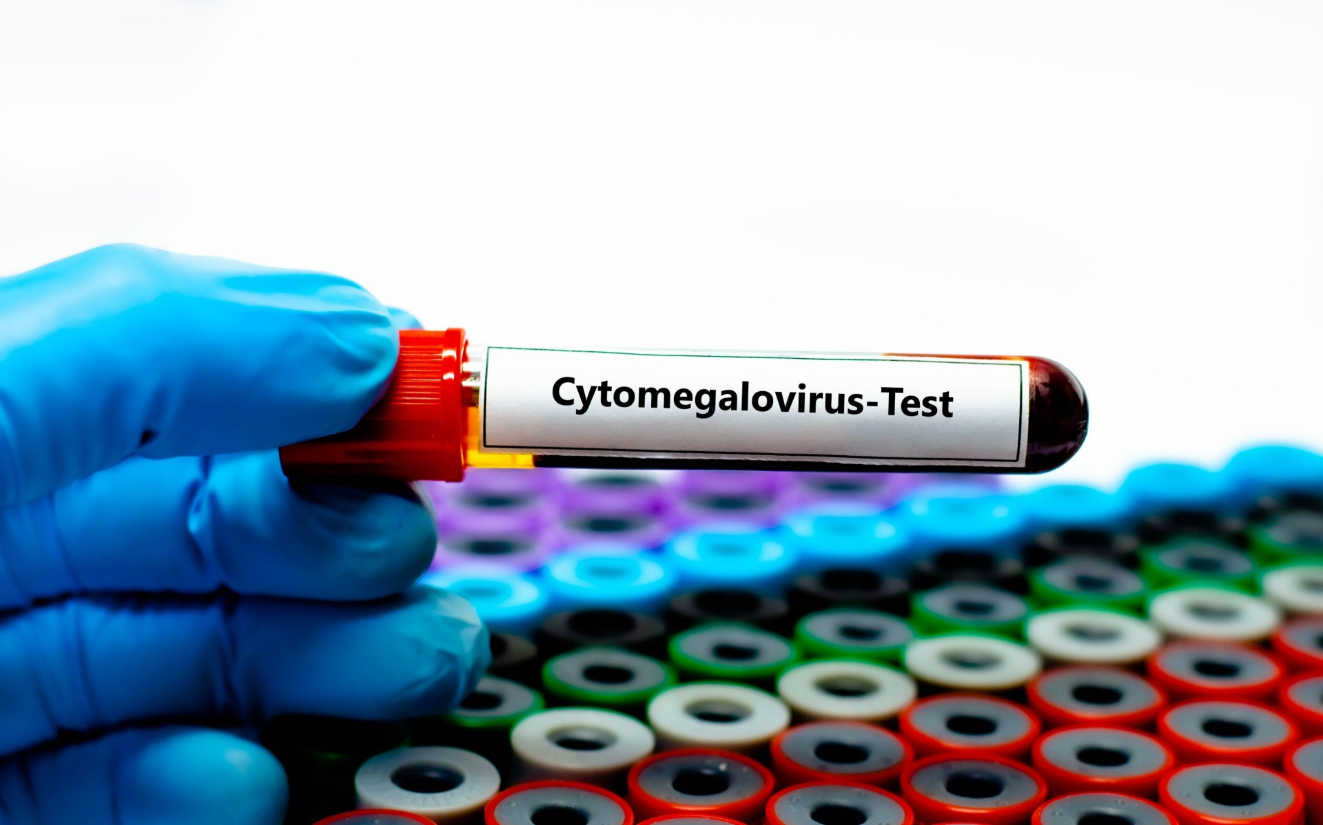 Cytomégalovirus : la HAS recommande un dépistage systématique chez les femmes enceintes