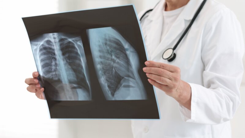 Adénocarcinome pulmonaire : la survie à 3 ans a doublé depuis 2000