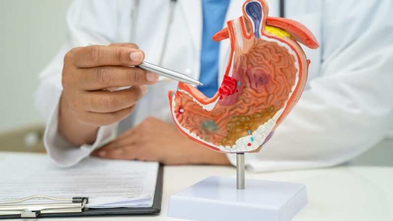 Cancers gastriques : un meilleur dépistage, une urgence mondiale