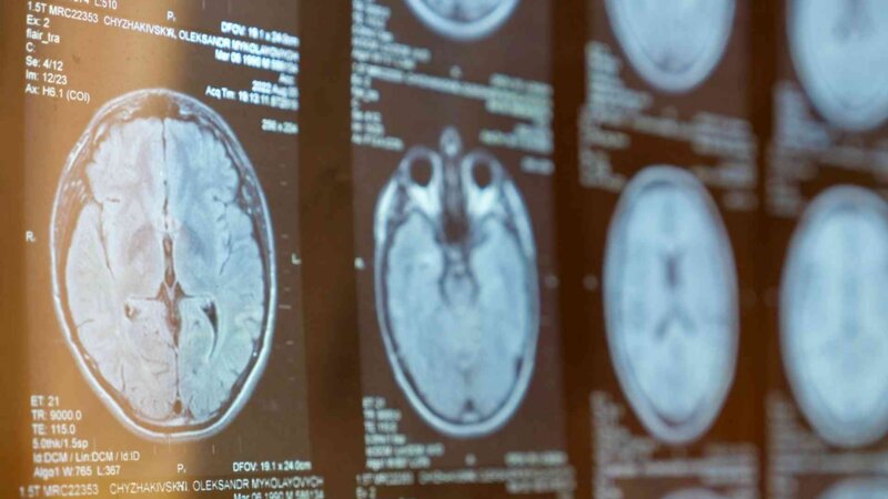 Sclérose en plaques : pourquoi notre système immunitaire se retourne-t-il contre nous ?