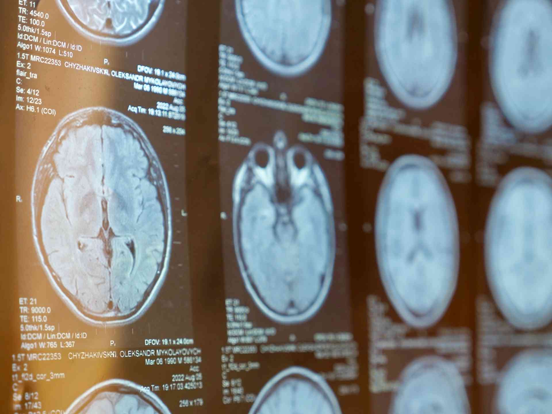 Sclérose en plaques : pourquoi notre système immunitaire se retourne-t-il contre nous ?