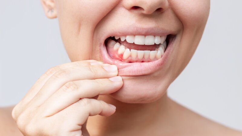 Santé bucco-dentaire : pourquoi faut-il prendre soin de ses gencives ?