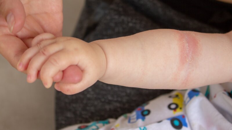 Eczéma des bébés : le stress des mères durant la grossesse à l’origine de la maladie ?
