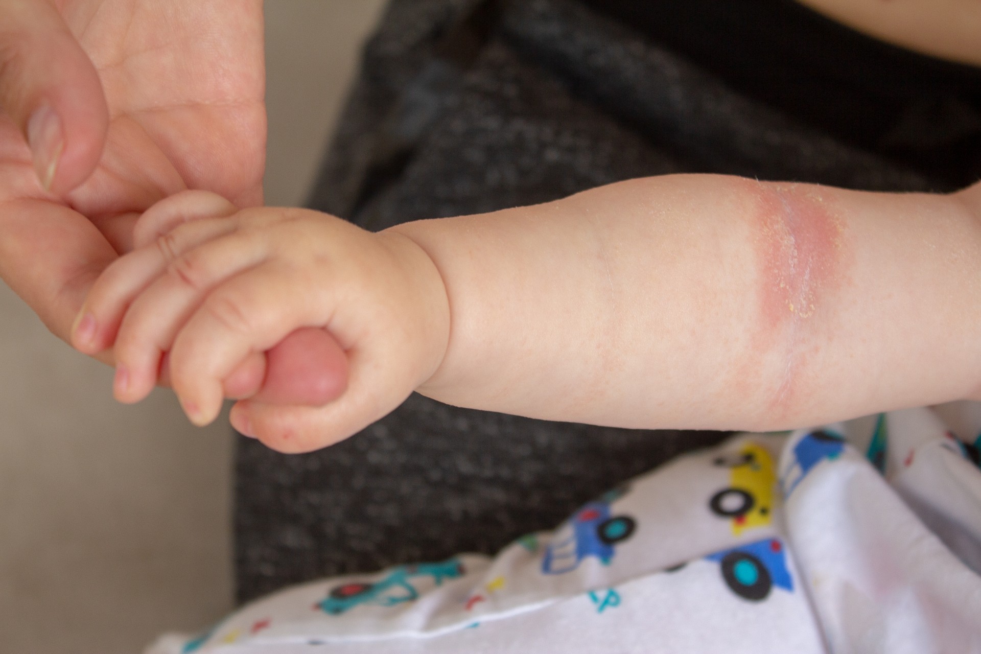 Eczéma des bébés : le stress des mères durant la grossesse à l’origine de la maladie ?