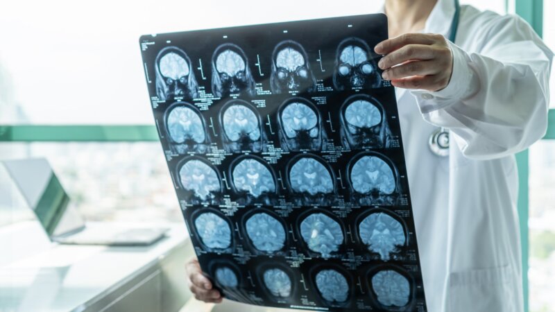 Alzheimer : une carence cérébrale en lithium aux origines de la maladie ?