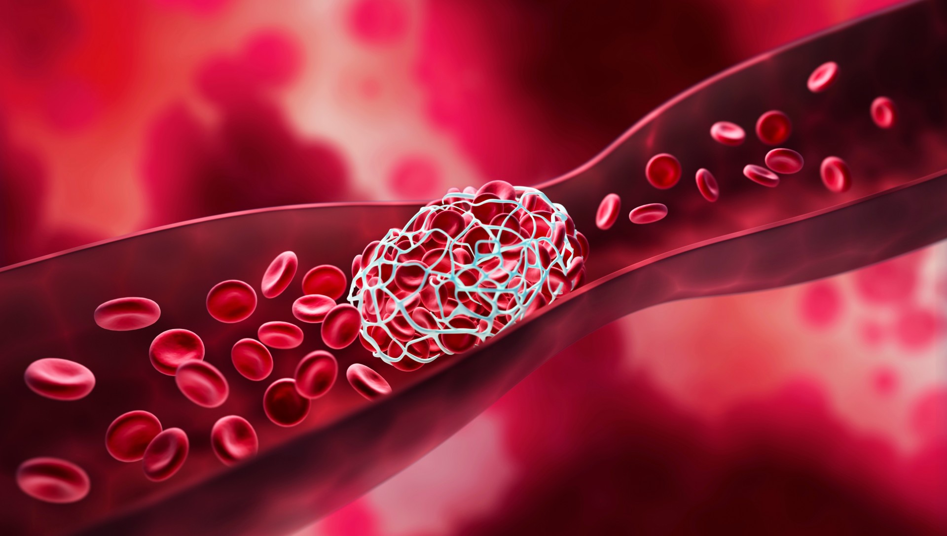 Maladie thromboembolique veineuse : pourra-t-on prévenir le risque de récidive ?