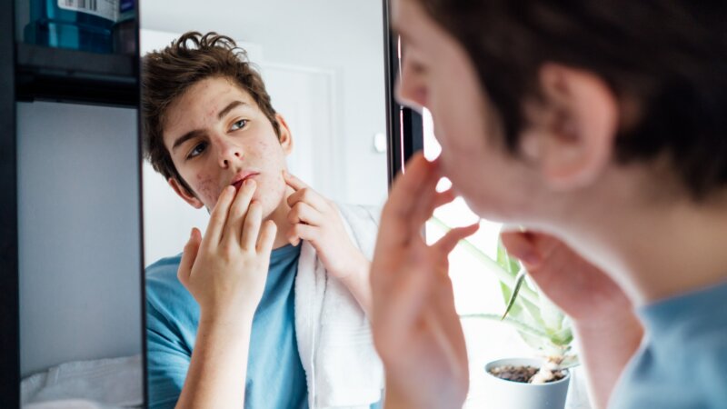 Acné : l’Agence européenne du médicament approuve un traitement novateur pour les adolescents