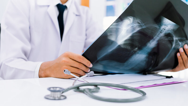 Cancer du poumon chez les non-fumeurs : la pollution en cause