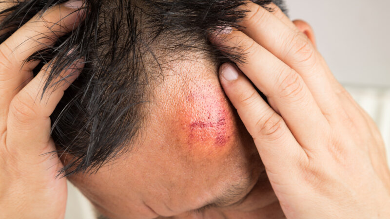 Après un choc, d’où vient cette bosse ?