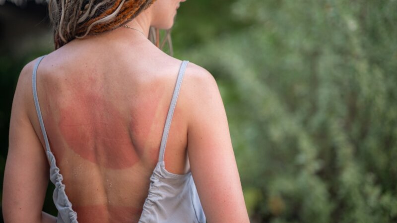 Coup de soleil : quand consulter ?