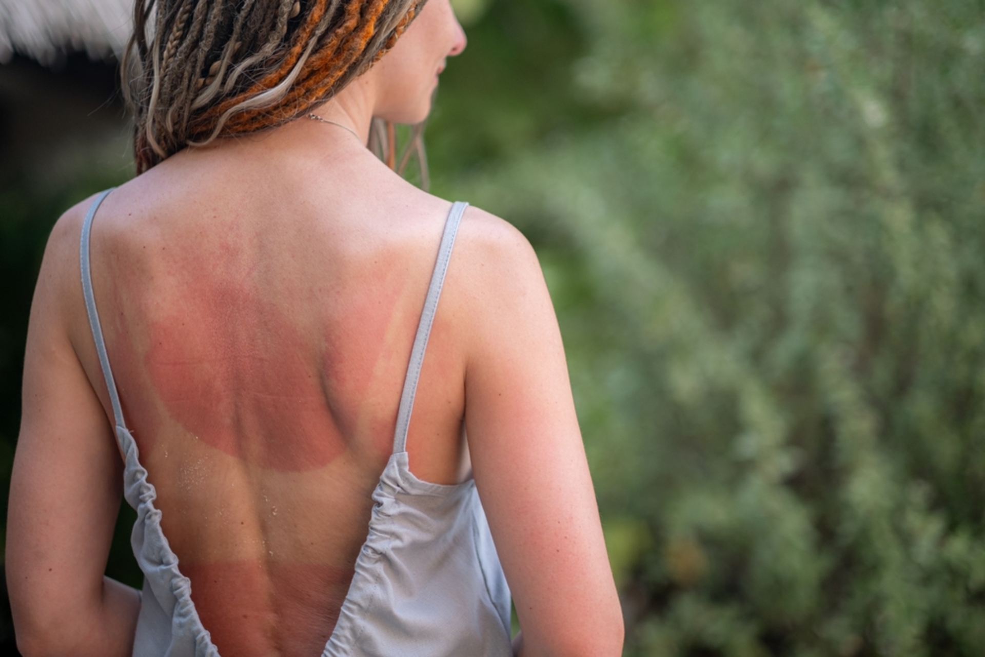 Coup de soleil : quand consulter ?